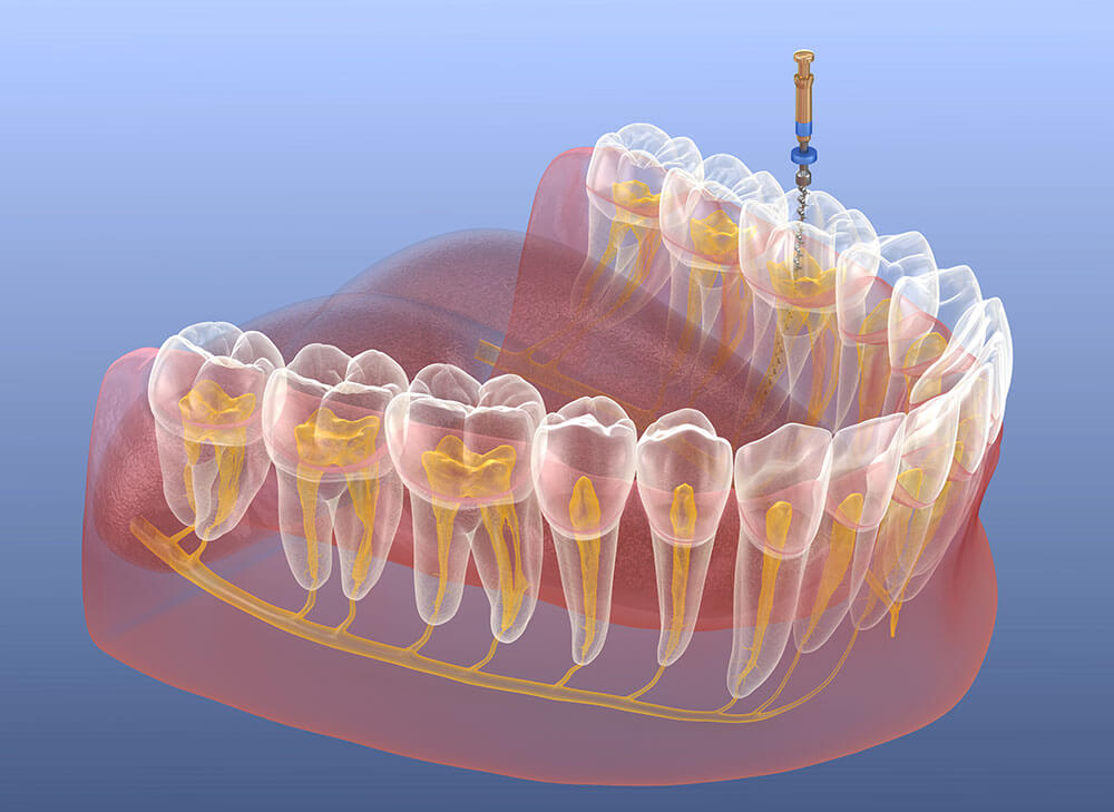What Happens During a Root Canal Procedure